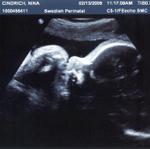 5th Ultrasound