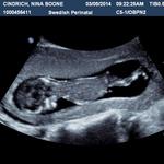 12 Week Ultrasound